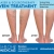 Laser & Sclerotherapy Vein Treatment