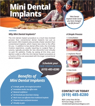 Benefits of Mini Dental Implants