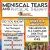 Meniscal Tears and Physical Therapy